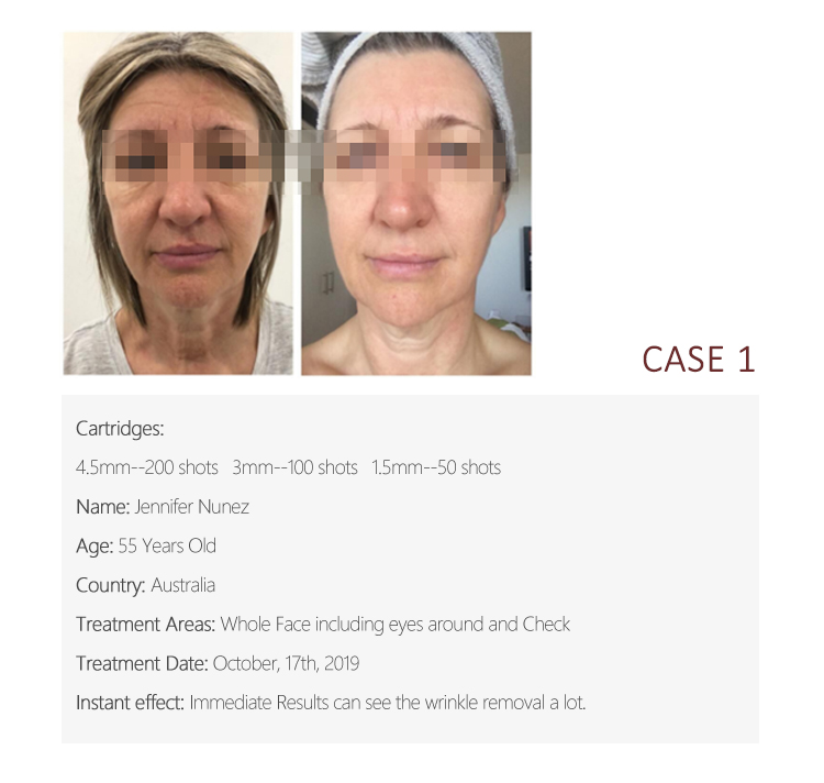 Other Beauty Equipment 3D Hifu Beauty Machine With 8 Cartridges For Face Lift Body Slimming Skin Tightening Wrinkle Removal