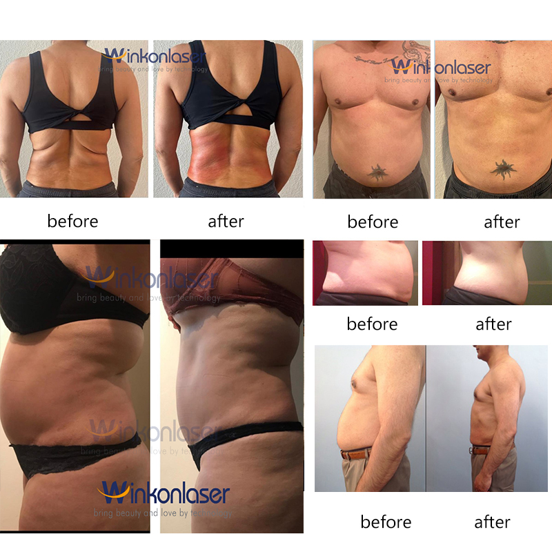 Cryotherapy 360 Cryolipolysis Machine Fat Freezing Body Slimming Fat Reduction Skin Tightening