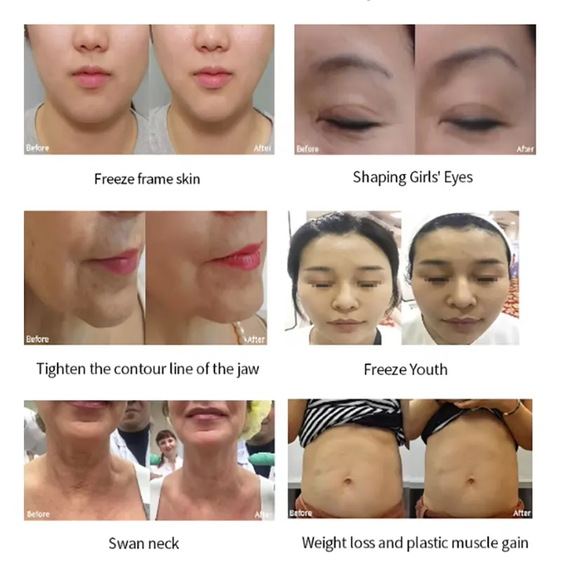 Anti Aging Machine Rf Radio Frequency Upgraded Micro Focused Dual Reverse Radio Frequency Skin Tightening Fractionated