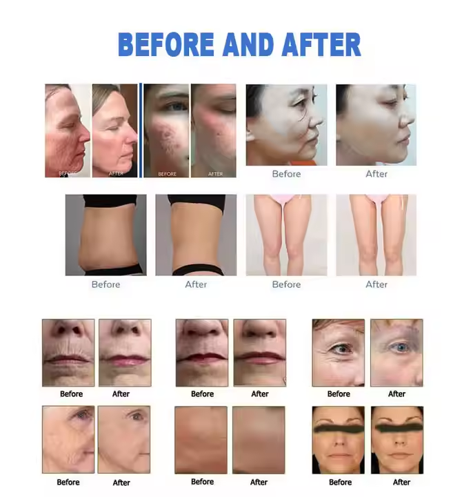 High Quality Portable 3 In 1 Hifu 4d 7d 9d 12d Facial Y Corporal Vmax Hifu Smas Face Lifting Body Slimming Machine