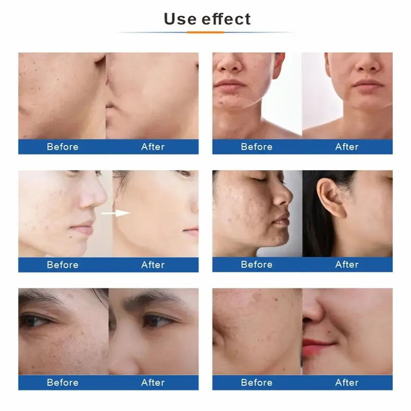 5 in 1 Oxygen Aqua Jet Peel Machine Oxygen Spray Skin Scrubber Diamond Microdermabrasion Machine Facial Deep Cleaning Skin Rejuvenation Machine