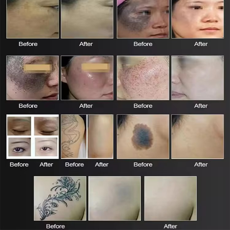 2025 Diode Laser Hair Removal Machine Depiladoral Portable Stable And Powerful Diode Laser Hair For Salon