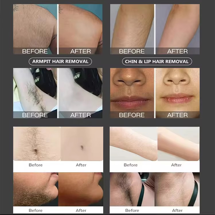 2025 Diode Laser Hair Removal Machine Depiladoral Portable Stable And Powerful Diode Laser Hair For Salon