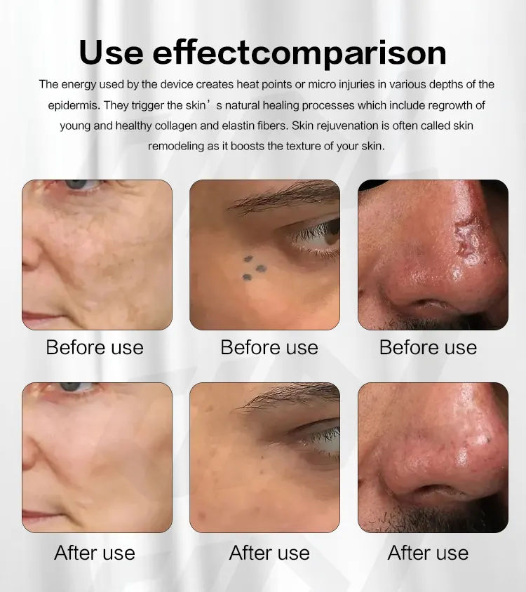 Professional Vertical Fractional Co2 Laser Beauty Machine Non Invasive Shaping Remover Anti-aging Machine