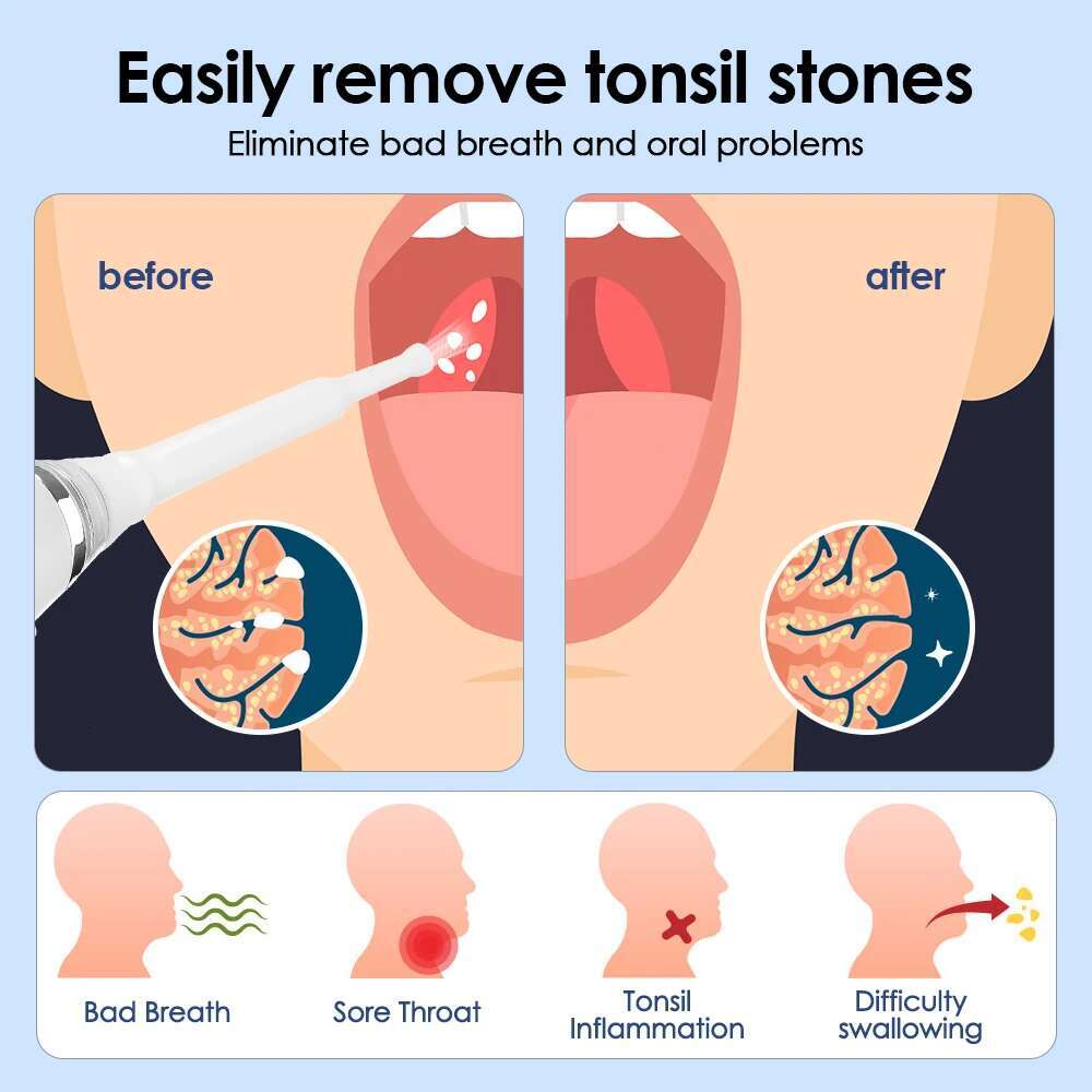 Electric Remover Vacuum Tonsil Stone Removal Kit With Irrigation Syringe Fight Bad Breath Irrigator Oral Fresh