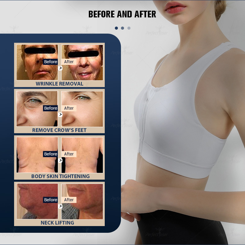 2025 9d hifu machine Anti Wrinkle removal Hifu Other Beauty Equipment Face Lifting Body Slimming Device Free Shipping