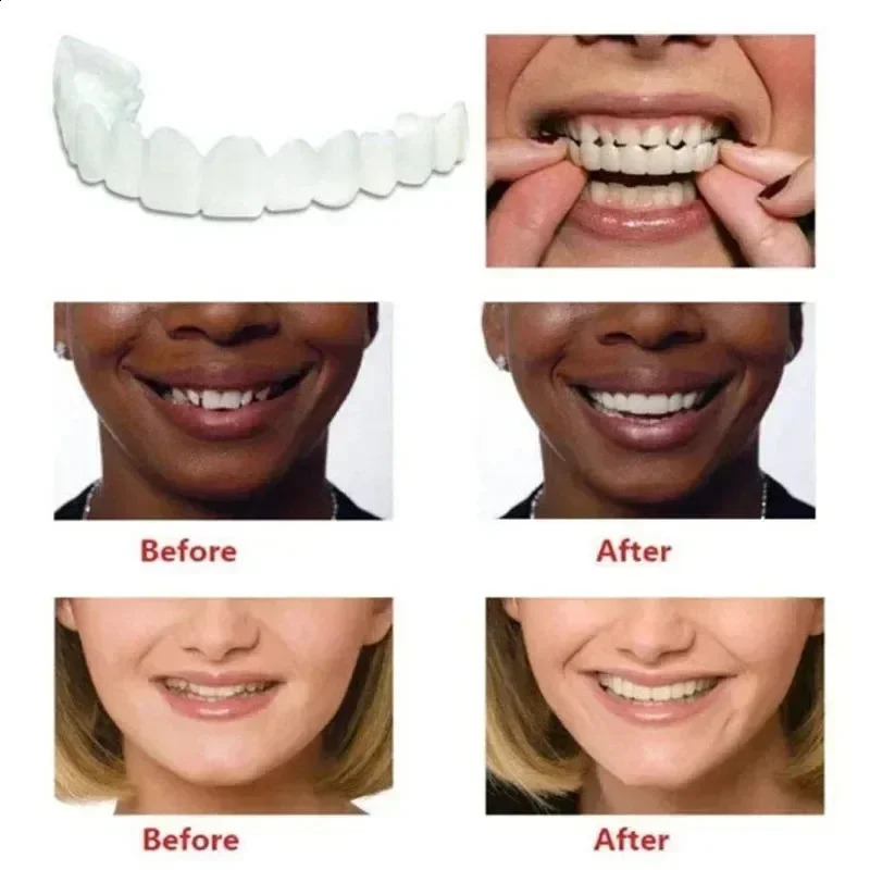 Upper Lower Teeth Cover Perfect Bright Veneers Comfort Fit Flex Dentures Braces Whitening 250122