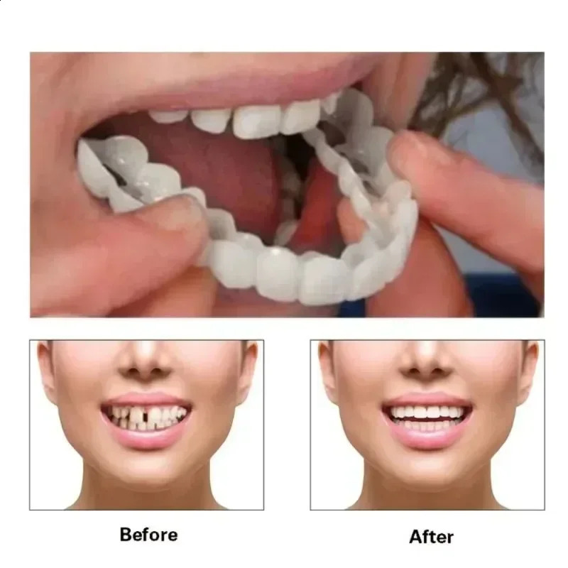 Upper Lower Teeth Cover Perfect Bright Veneers Comfort Fit Flex Dentures Braces Whitening 250122