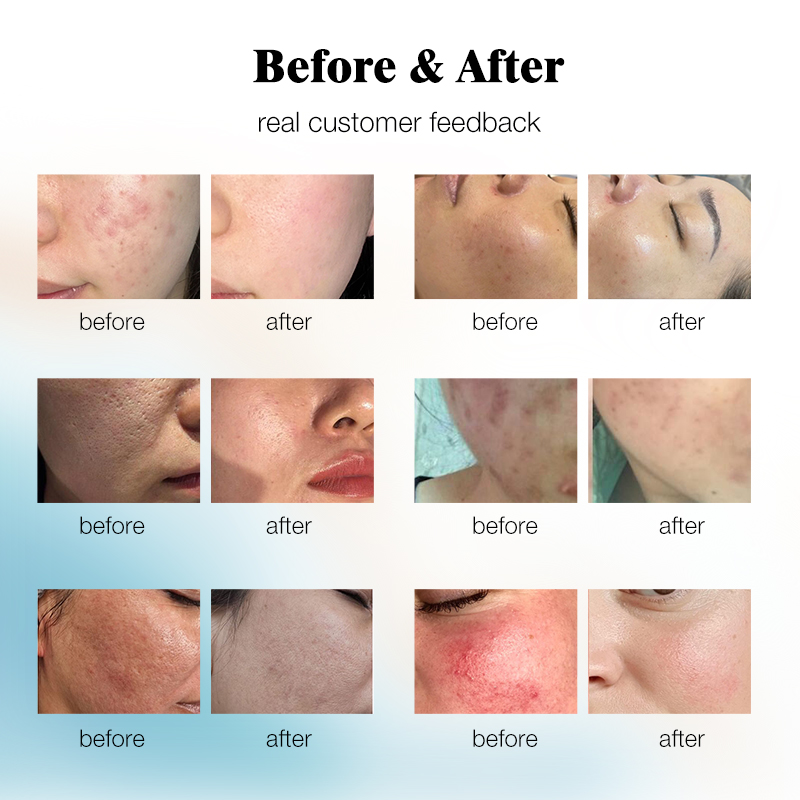 New Microdermabrasion Diamond Dermabrasion Peeling Machine Facial Peel Blackhead Removal Skin Care Beauty Instrument CE