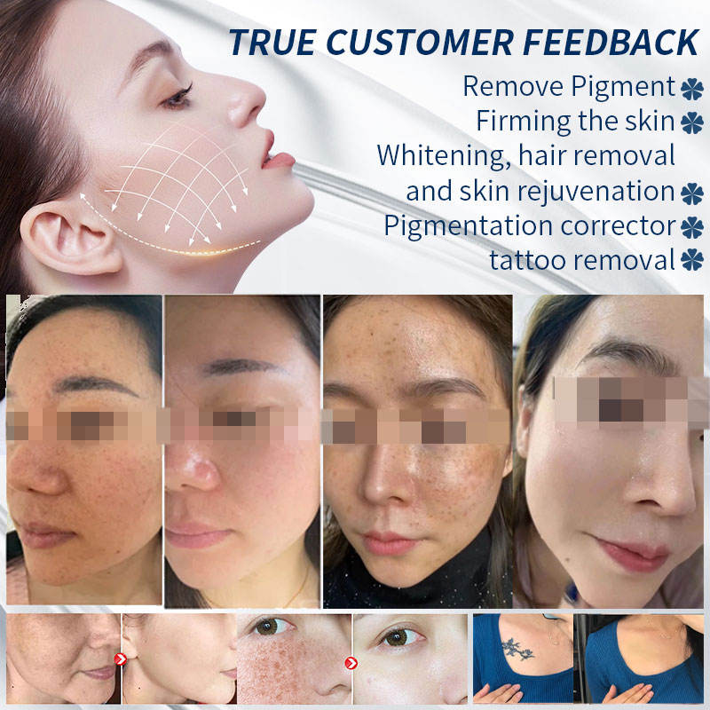 Good Quality Pico Laser Tattoo Removal Machine Q Switched Nd Yag Laser Condenser 24H Working Pigment Eyebrow Eyeline Freckle Removal Skin Color Bright