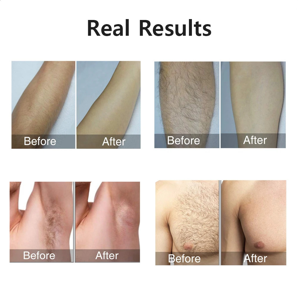 Portable IPL Laser Epilator 999999 Flashes - Painless Permanent Hair Removal for Women's Body and Bikini Line 250805