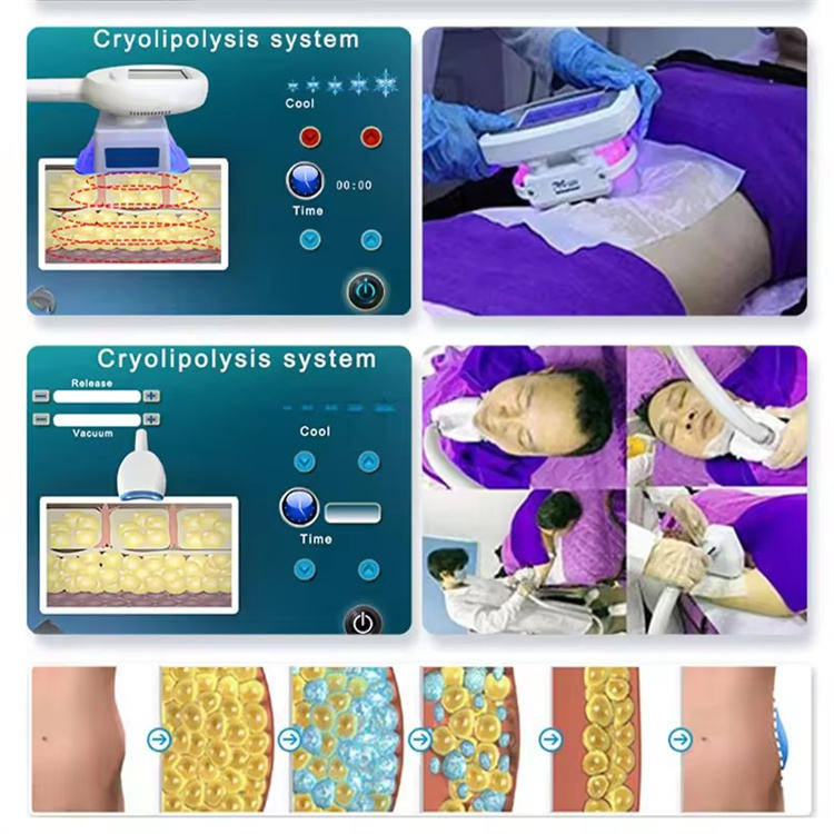 Portable 360 Cryo Double Chin Removal Fat Freezing Cryolipolysis Body Slimming Cryotherapy Machine Criolipolisis