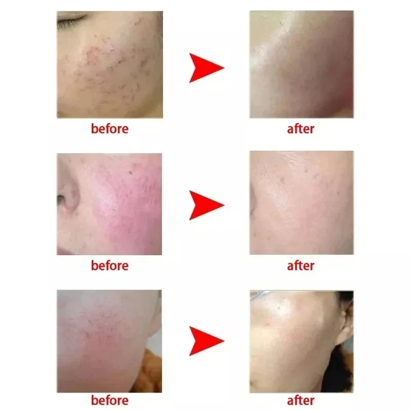 High Frequency Needle Spider Veins Removal Anti Redness Machine Red Blood Vessel and Spots Vascular Removal Beauty Equipment