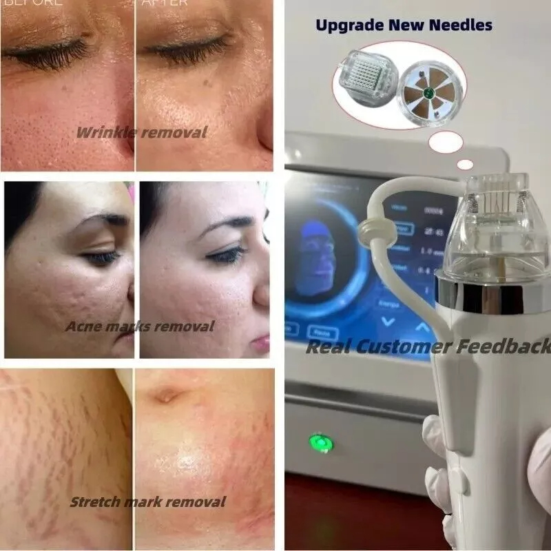 2025 Portable Skin Tightening Score Micro Needle Tightening and Wrinkle Removal, Scar Repair, Portable 2-in-1 Gold RF Score Micro Needle Machine with 