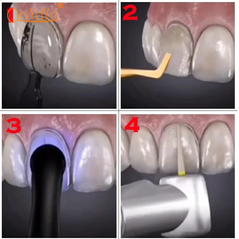 Dental Mould for Composite Resin Veneers Light Cure Filling Anterior Front Teeth Mould Teeth Whitening Tools 250227