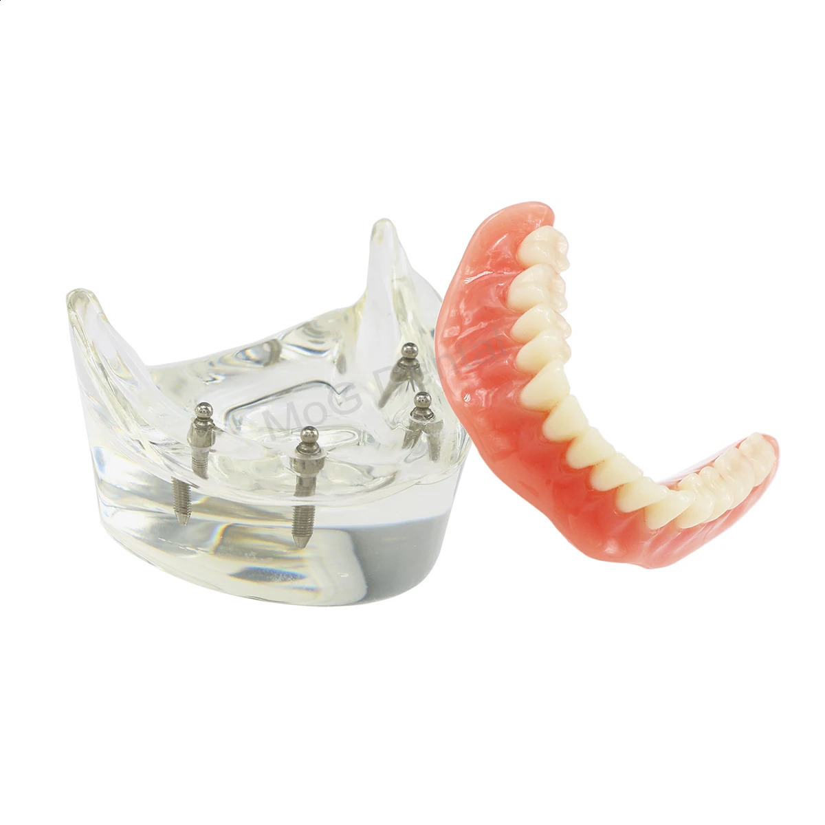 Dental Implant Teeth Model with Overdenture Inferior Demo 4 Implants Dental Teaching Model for Lab Demonstration Tools M6003 250228