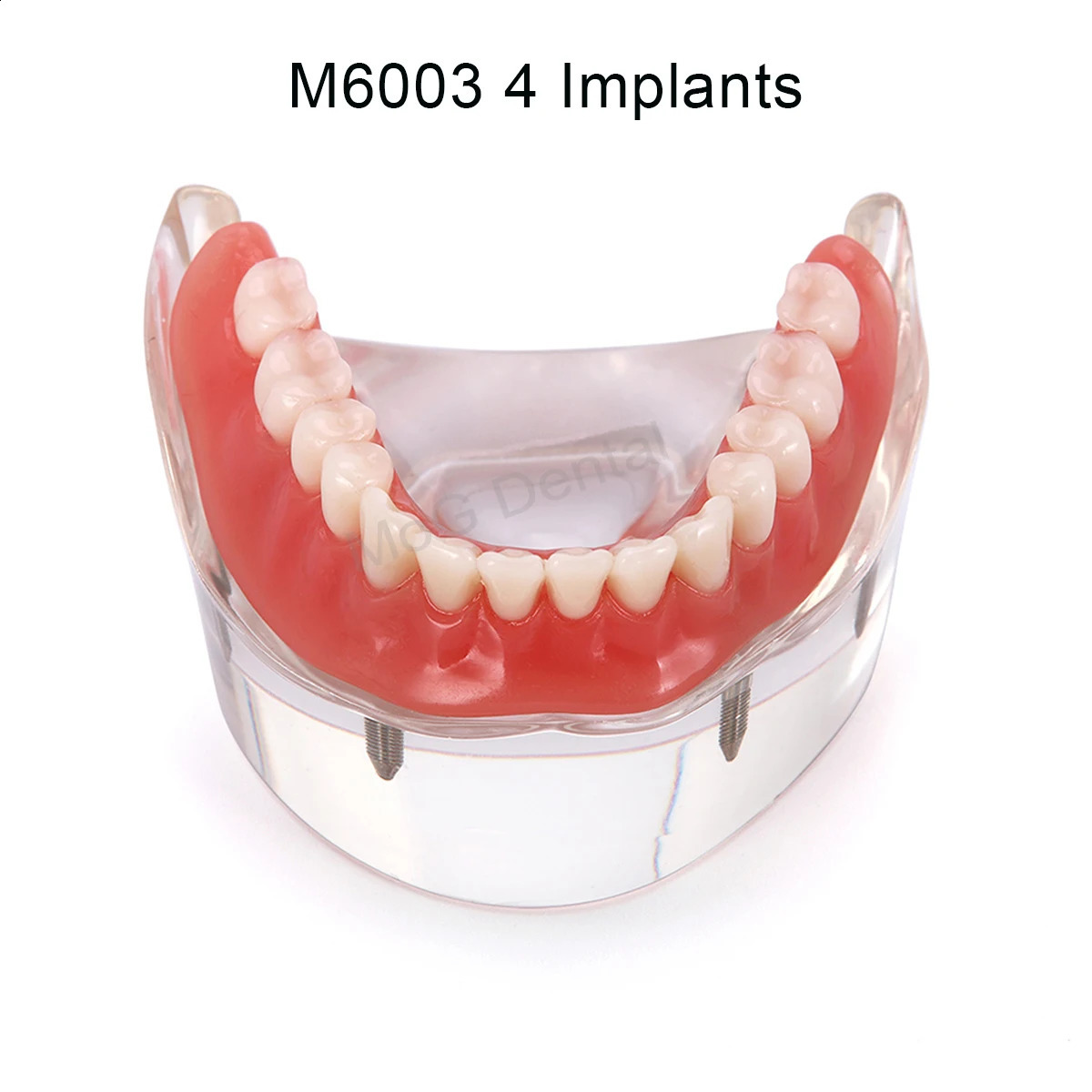 Dental Implant Teeth Model with Overdenture Inferior Demo 4 Implants Dental Teaching Model for Lab Demonstration Tools M6003 250228