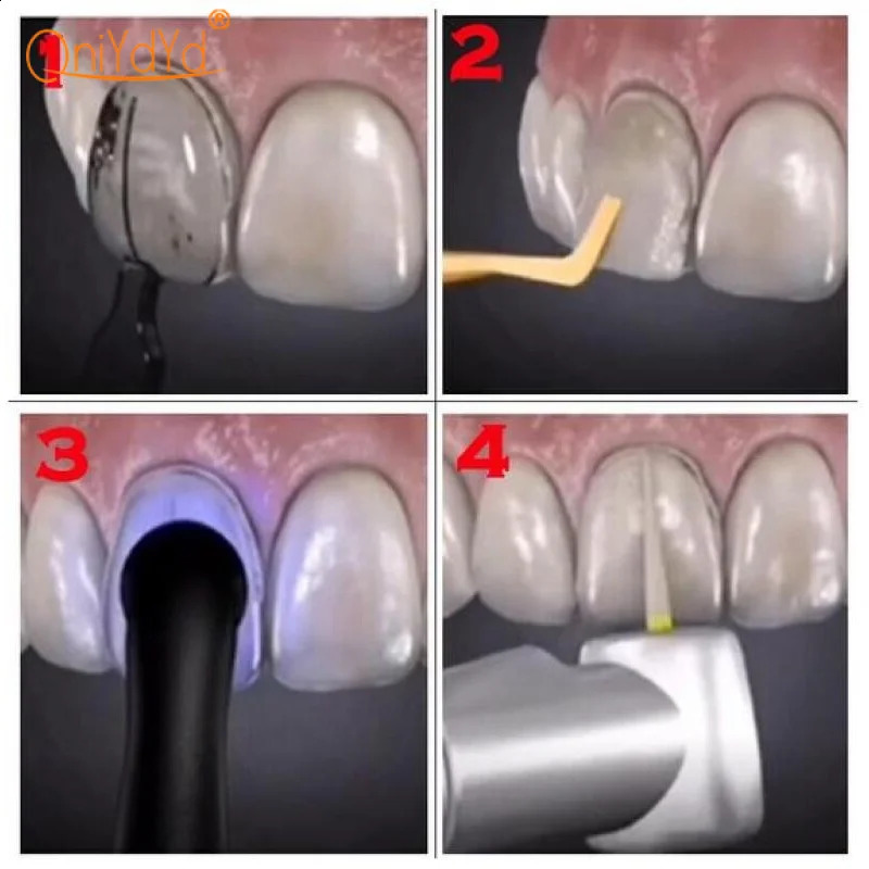 1set Dental Veneer Mold Box Composite Resin Light Cured Front Teeth Rapid Dental Tool 250228