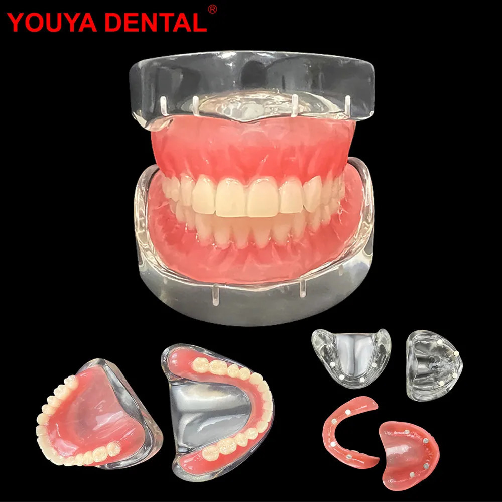 Dental Teaching Model Implant Teeth Model Removable Upper Lower Jaw Models Maxillary Mandibular With 4 Implant Study Overdenture 250228