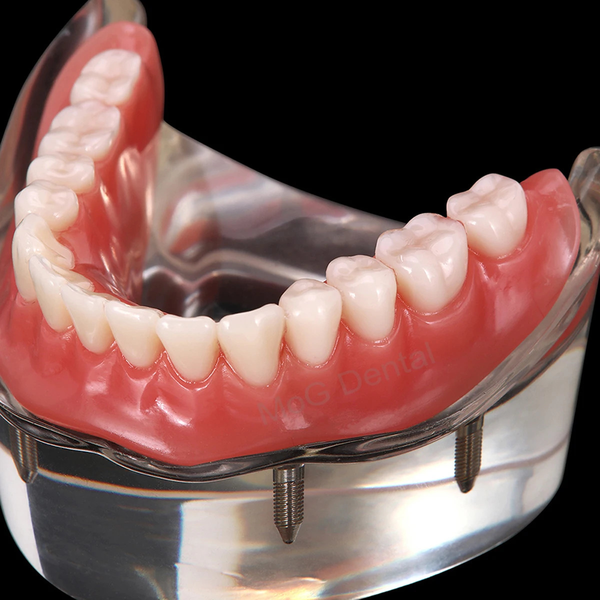 Dental Implant Teeth Model with Overdenture Inferior Demo 4 Implants Dental Teaching Model for Lab Demonstration Tools M6003 250228