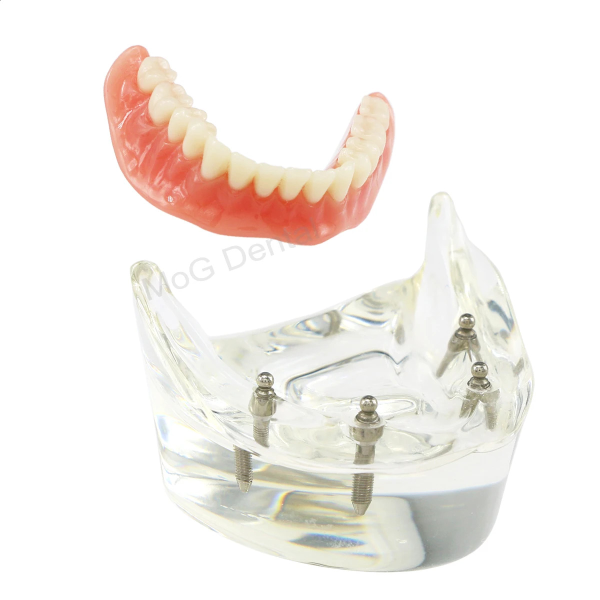 Dental Implant Teeth Model with Overdenture Inferior Demo 4 Implants Dental Teaching Model for Lab Demonstration Tools M6003 250228