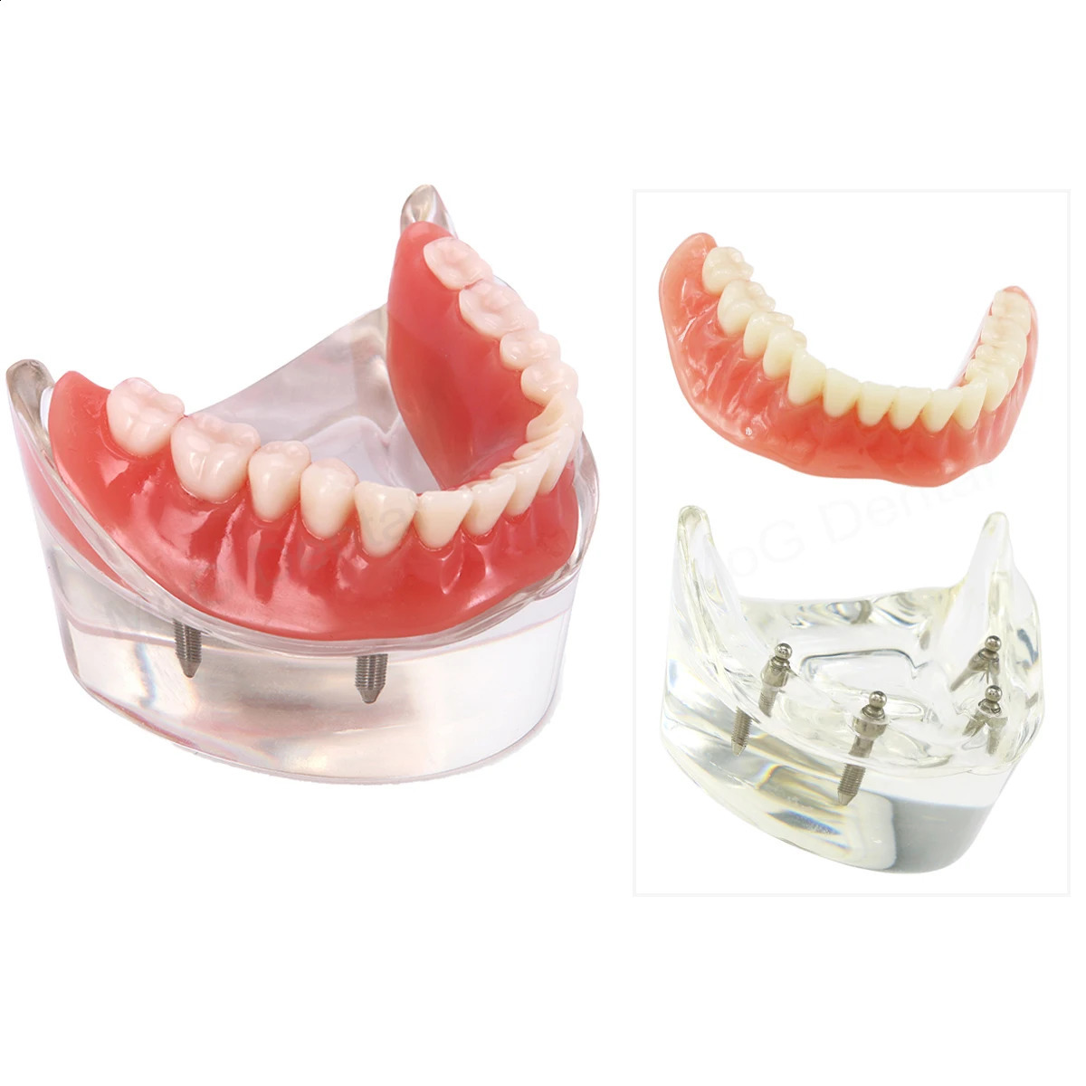 Dental Implant Teeth Model with Overdenture Inferior Demo 4 Implants Dental Teaching Model for Lab Demonstration Tools M6003 250228