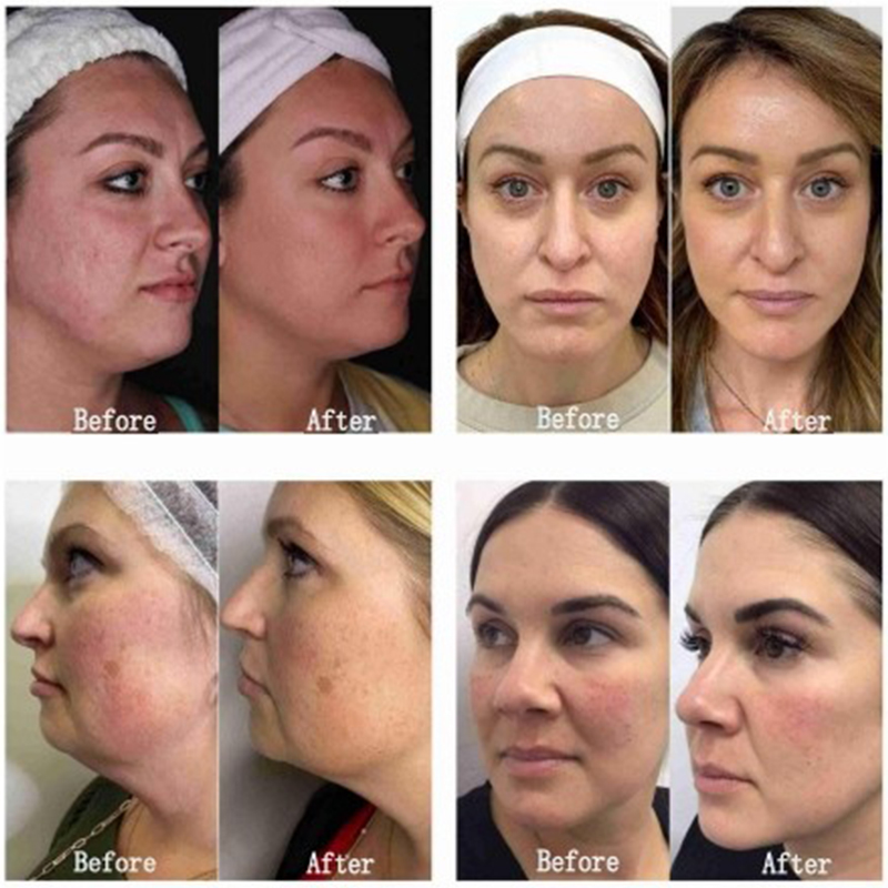 Korean hifu ultherapy Vmax Microneedle RF 3 in 1 machine