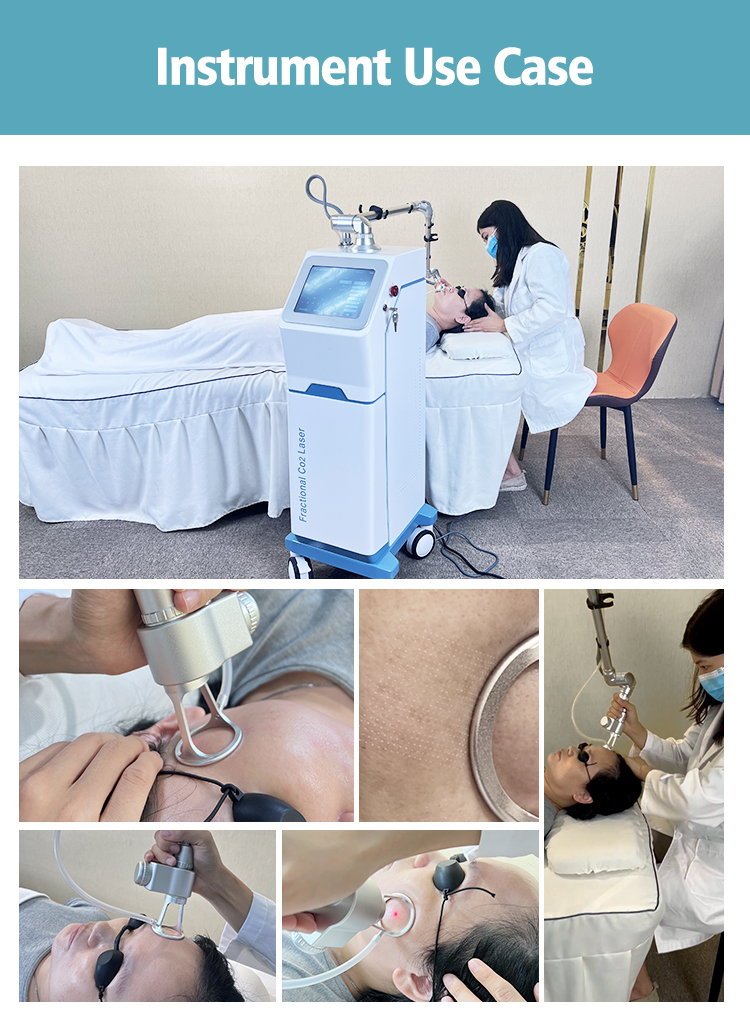 Best Selling CO2 Fractional Laser for Precision Treatment for Acne Stretch Marks Scars Removal