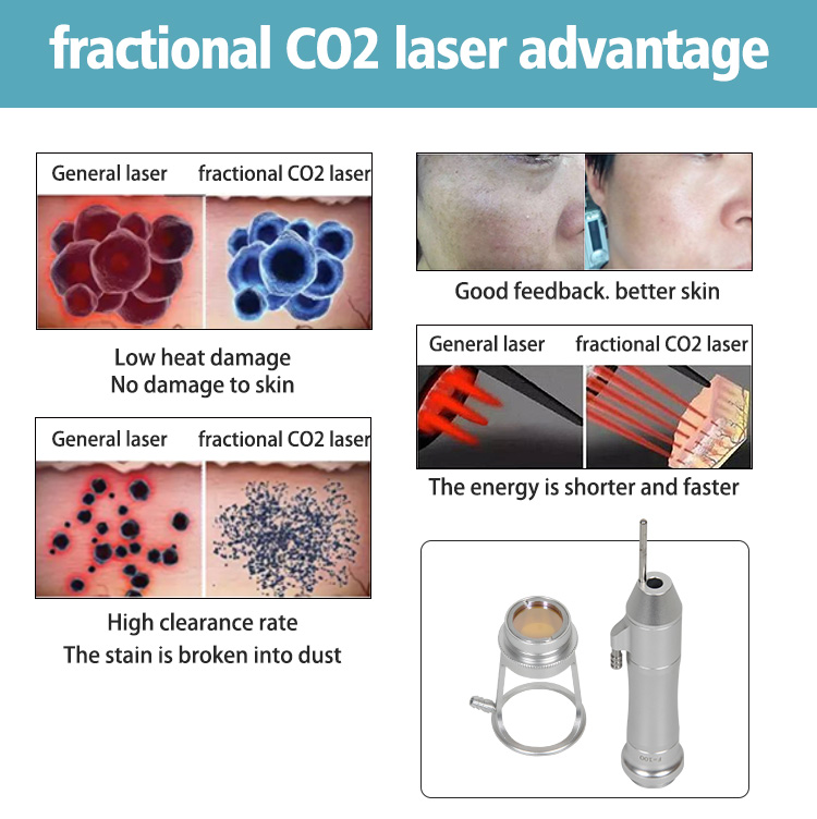 Best Selling CO2 Fractional Laser for Precision Treatment for Acne Stretch Marks Scars Removal
