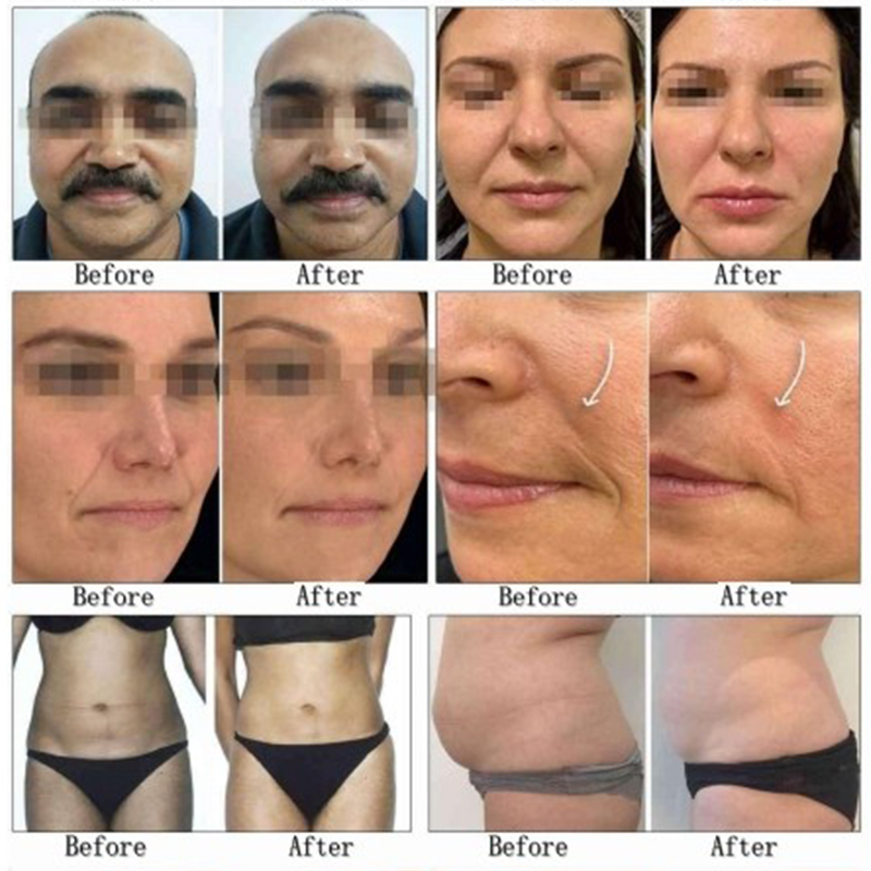 Korean hifu ultherapy Vmax Microneedle RF 3 in 1 machine