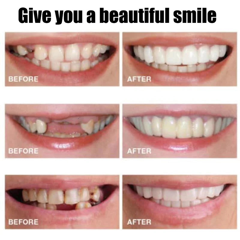 False Teeth Silicone Upper Lower Veneers Dentures Paste Fake Teeth Braces Perfect Laugh Veneers Comfortable Teeth Orthodontic Ma 250228
