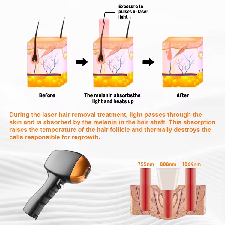 2025 Professional Ice Platinum Titanium 808nm Diode Laser Device 3 Wavelength 755 808 1064 Diode Laser Hair Removal Machine
