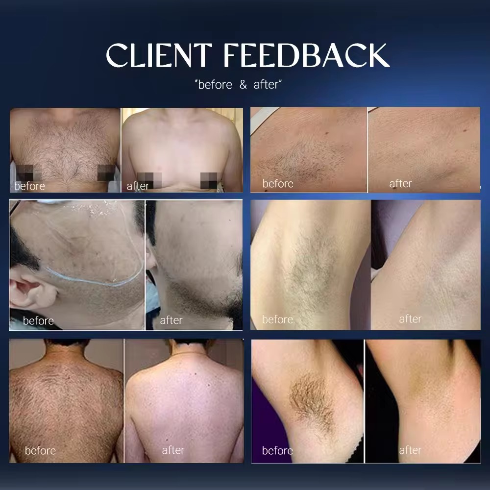 2025 Professional Ice Platinum Titanium 808nm Diode Laser Device 3 Wavelength 755 808 1064 Diode Laser Hair Removal Machine