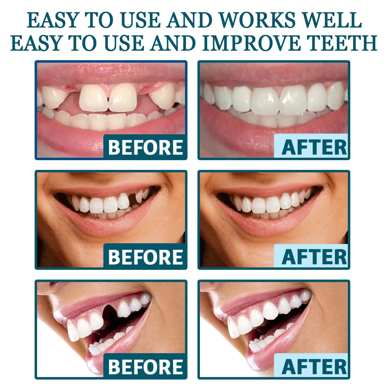 Adjustable Snap-on Dentures Simulation BracesFake Teeth Comfortable Veneer Cover The Imperfect Teeth Strips and Fake Brace 250306