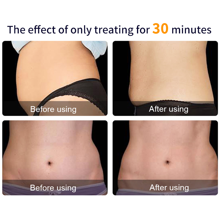 Electrical Muscle Stimulation (EMS) Massager for Women Anti-Cellulite Treatment