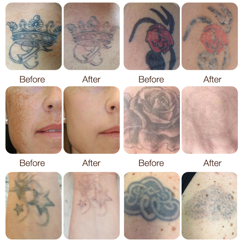 Fast Delivery Picosecond laser Machine 1064 Laser Q-switched System Nd Yag Laser Pico laser Tattoo Removal equipment 2 years warranty
