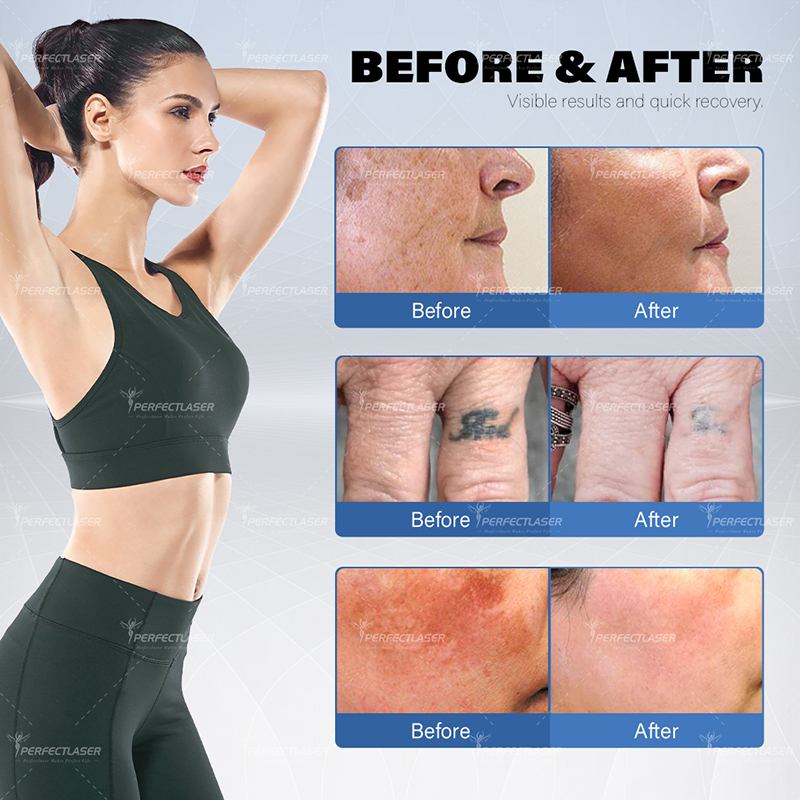 CE ISO Certified Portable Picosecond Laser Machine for Laser Tattoo Removal and Skin Care carbon peel laser machine