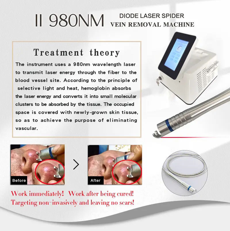 Diode Laser 980Nm Spider Vein Removal Machine Diode Laser Physiotherapy Vascular Therapy Varicose Treatment 30W Laser Diode Vascular Vein Remove Machi