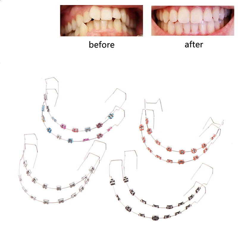 1 Pair Dental Decorations Colorful Temporary Tooth With Metal Wires Metal Bracket And Orthodontic Ligature Ties 250327