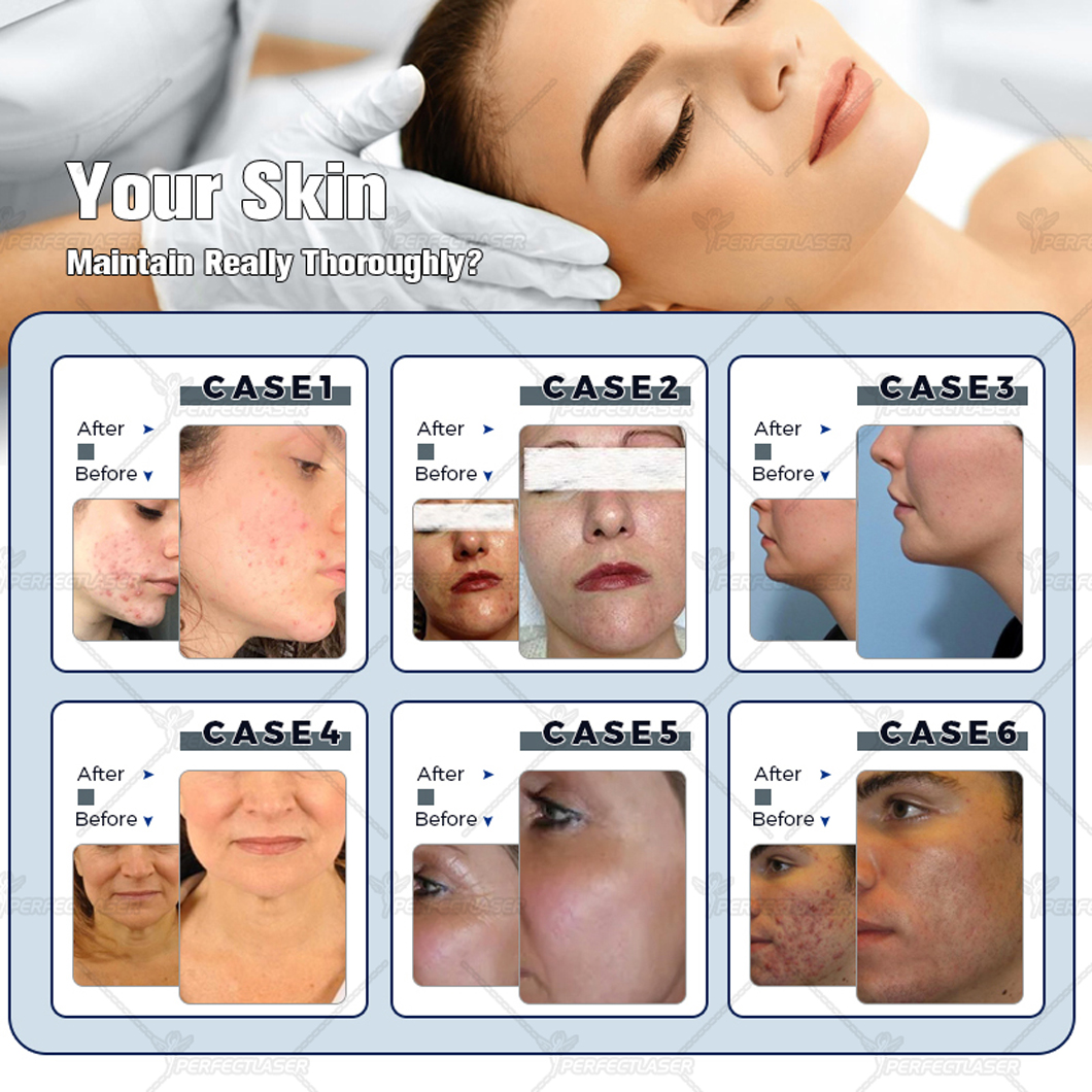 14 IN 1 H2O Dermabrasion Facial Machine Aqua Face Clean Microdermabrasion Professional Oxygen Facial Equipment Crystal Diamond Water Peeling