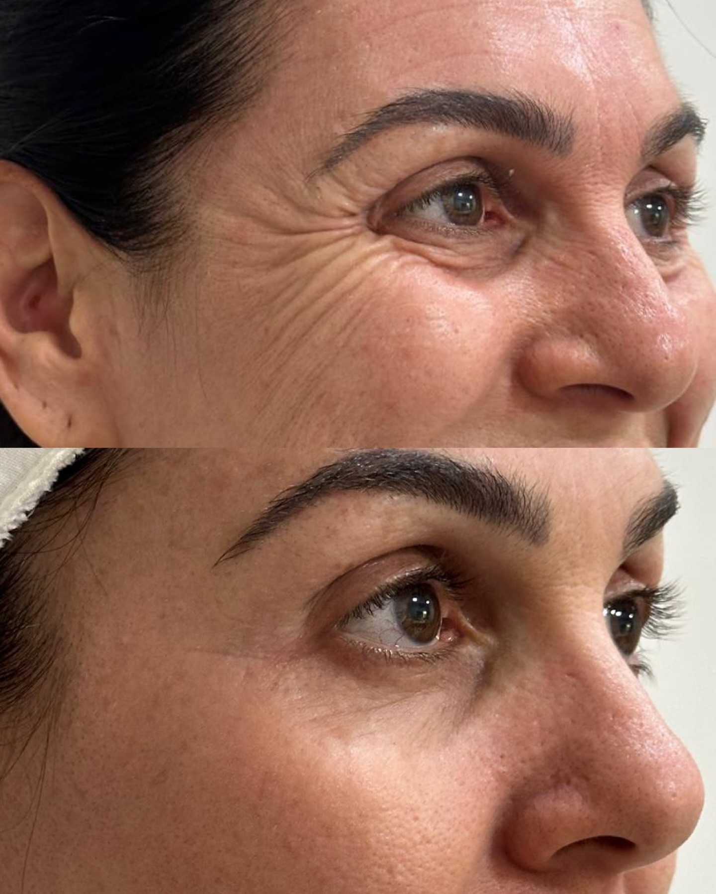 Korea Effective Anti-Wrinkle Freeze-Dried Powder for Face Lifting Firming Forehead Cheeks Eye Corners Anti-wrinkle Face lifting 100 units