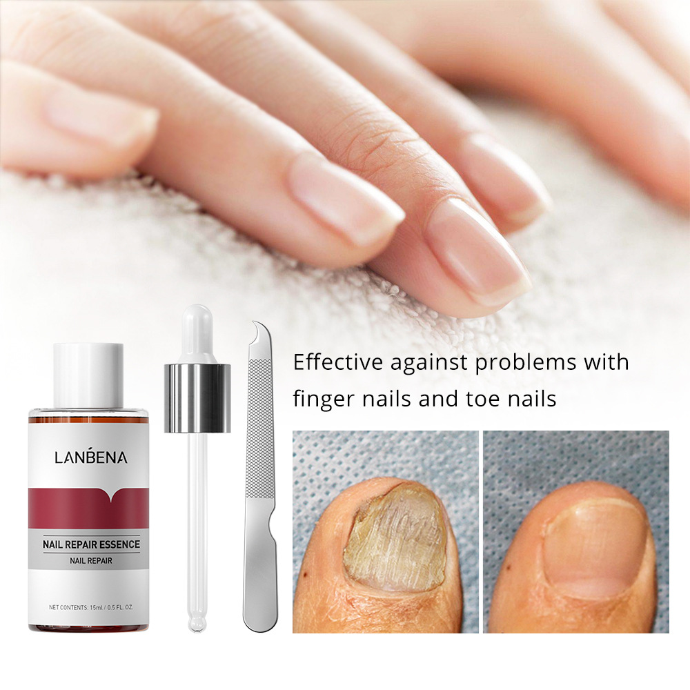 Fungal Nail Repair Essence 15ML Equipped With A Small File