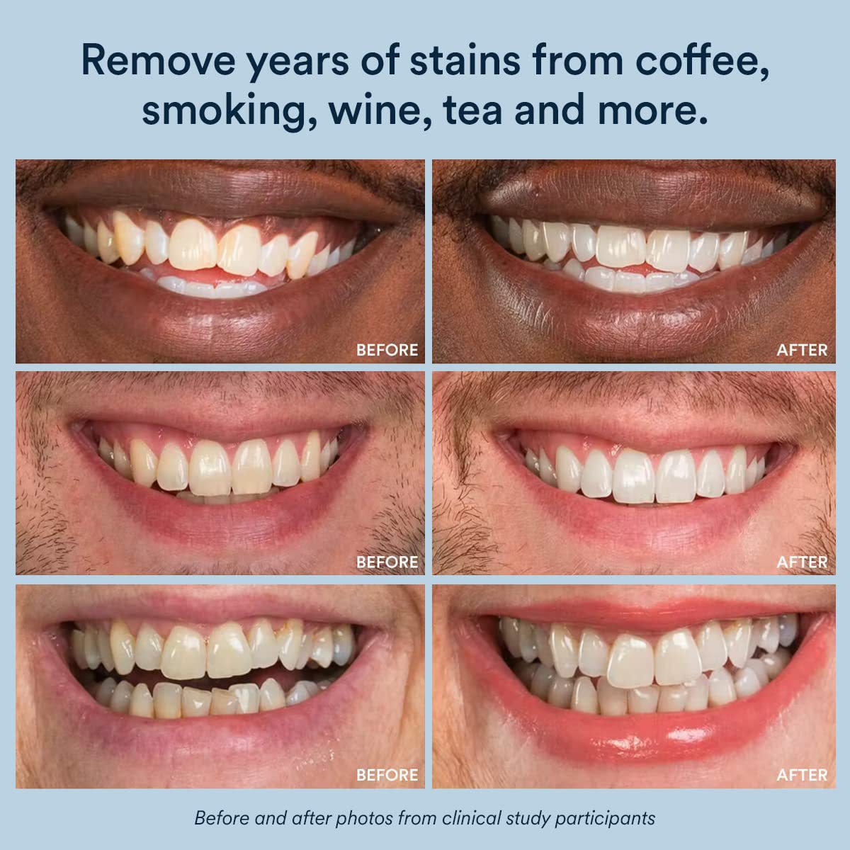 2025 Home Use Inno White Tooth Whitening Oral Hygiene Gel Kits Dental Teeth Whitening Gel