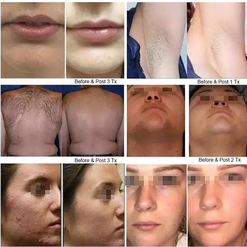 CE clearance755 808 1064nm diode laser hair removal machine ICE laser soprano laser Skin Tightening Beauty Equipment 1 years warranty logo customizati