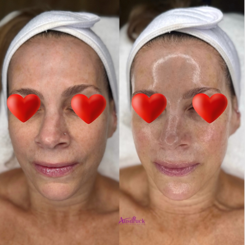 Hydradermabrasion Facial Aquafacial Peeling Hydro Shrink Pore Facial Firming Diamond Dermabrasion H2o2 Microdermabrasion Device