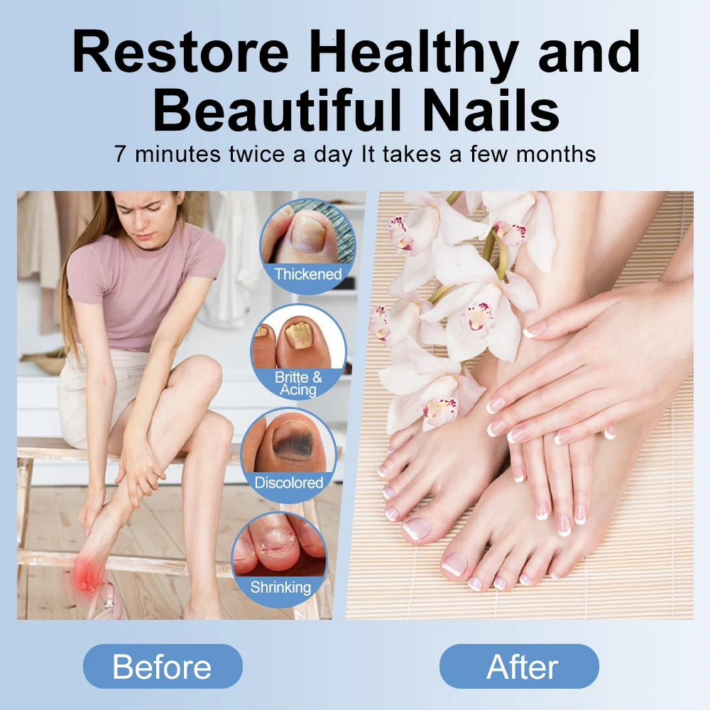 Nail Fungus Treatment UV LED Lamp Laser Device for Cleaning Onychomycosis USB Charge UV Light for Nail Sterilize Repair Care 250627