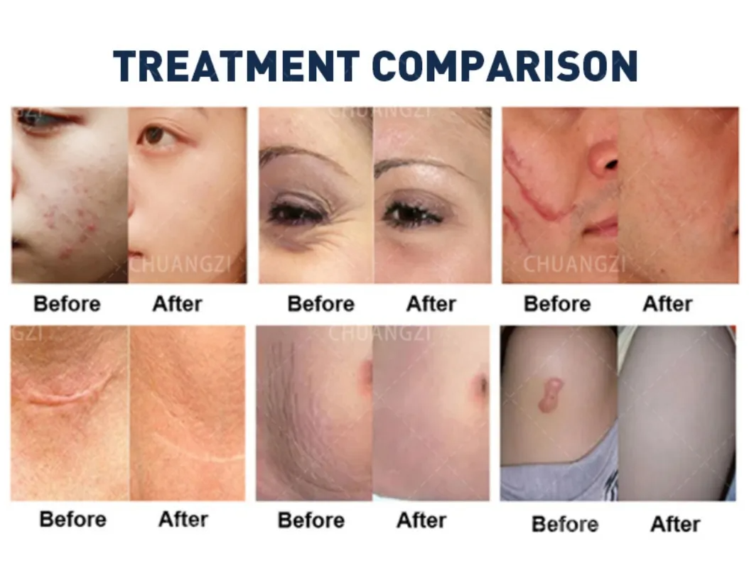 High Precision 10600nm Fractional CO2 Laser Equipment for Scar Repair, Collagen Boosting and Skin Firming Treatment