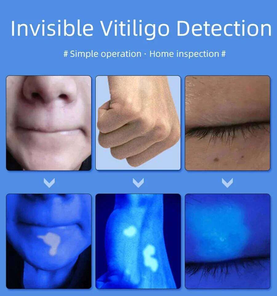 Woods Analyzer UV Magnifying For Beauty Facial Testing Wood Lamp Light Analysis Detection Skin Care