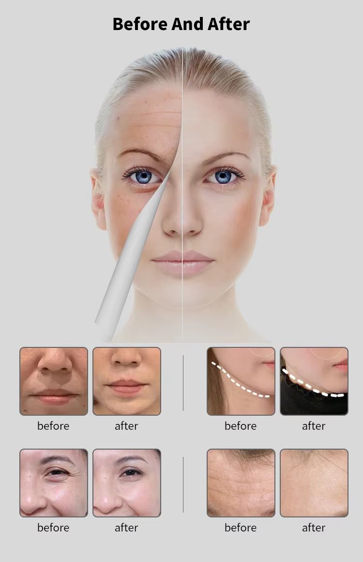 2025 Professional Volnemeer Face Lifting Machine Wrinkle Removal Machine Skin Care Beauty Instrument 6.78mhz Monopolar Radio Face Lift