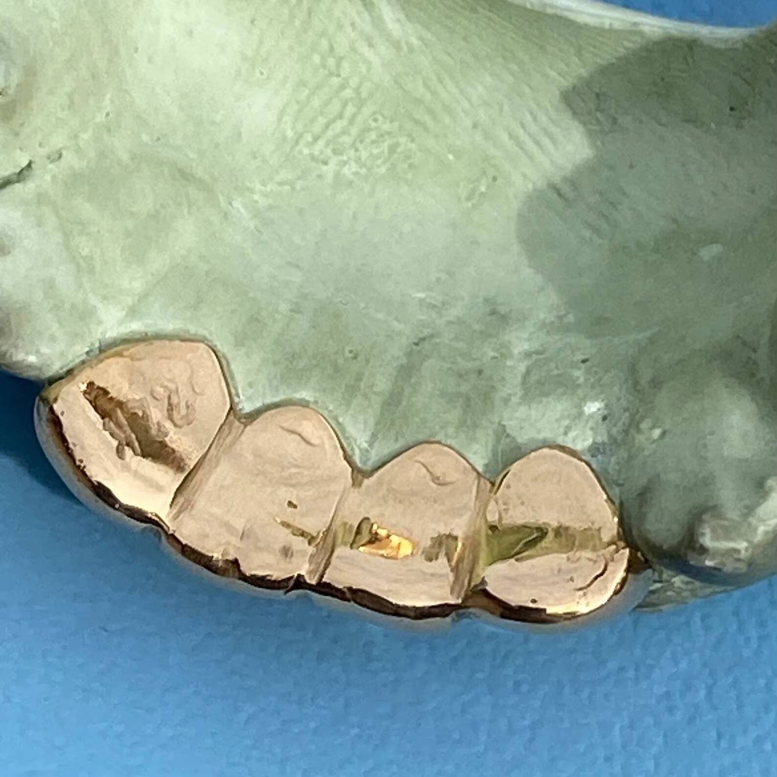 Real Solid 22K Gold Custom Grillz Teeth Grill or Single One Tooth Cap 4 Top and 4 Bottom Moissanite Diamond Teeth Grillz for Men